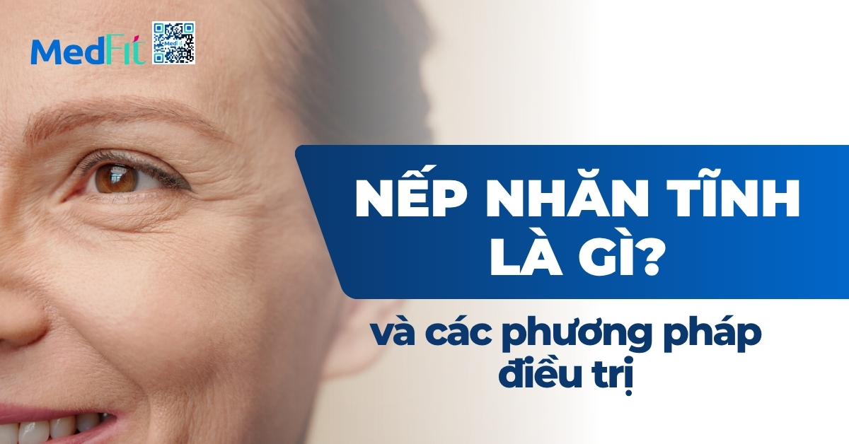 nếp nhăn tĩnh là gì và các phương pháp điều trị