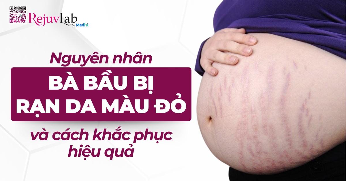 nguyên nhân bà bầu bị rạn da màu đỏ và cách khắc phục hiệu quả