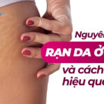 Nguyên nhân bị rạn da ở mông và cách xử lý hiệu quả