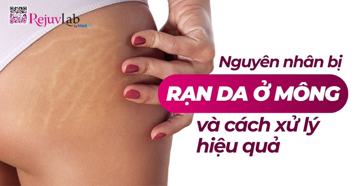 nguyên nhân bị rạn da ở mông và cách xử lý hiệu quả