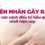 Rạn da tuổi dậy thì có hết không? Sự thật và cách điều trị 2 Nguyên nhân gây rạn da và các cách điều trị hiệu quả nhất hiện nay