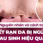 Rạn da sau sinh có hết không? Cách điều trị hiệu quả 4 Nguyên nhân và cách trị vết rạn da bị ngứa sau sinh hiệu quả