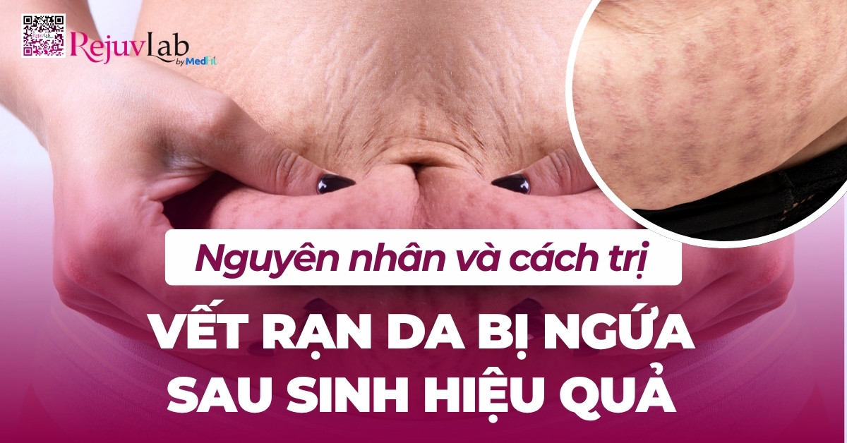 nguyên nhân và cách trị vết rạn da bị ngứa sau sinh hiệu quả