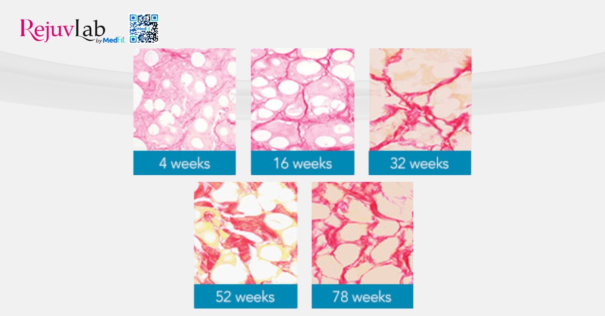 radiesse kích thích tăng sinh collagen