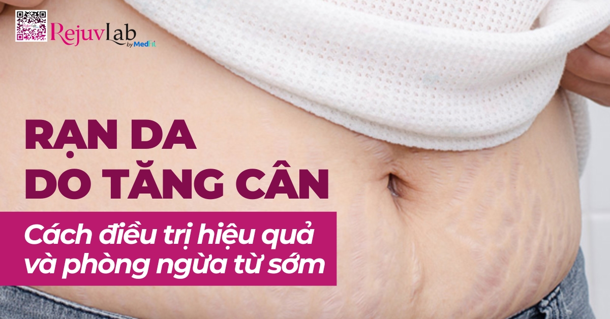 rạn da do tăng cân cách điều trị và phòng ngừa