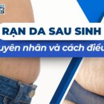Rạn da sau sinh: Nguyên nhân và cách điều trị