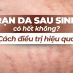 Nguyên nhân và cách trị vết rạn da bị ngứa sau sinh hiệu quả 9 Rạn da sau sinh có hết không? Cách điều trị hiệu quả