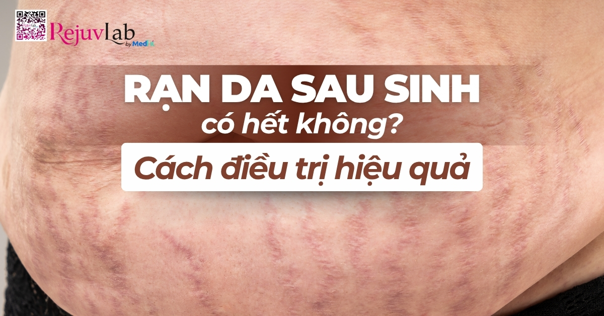 rạn da sau sinh có hết không cách điều trị hiệu quả