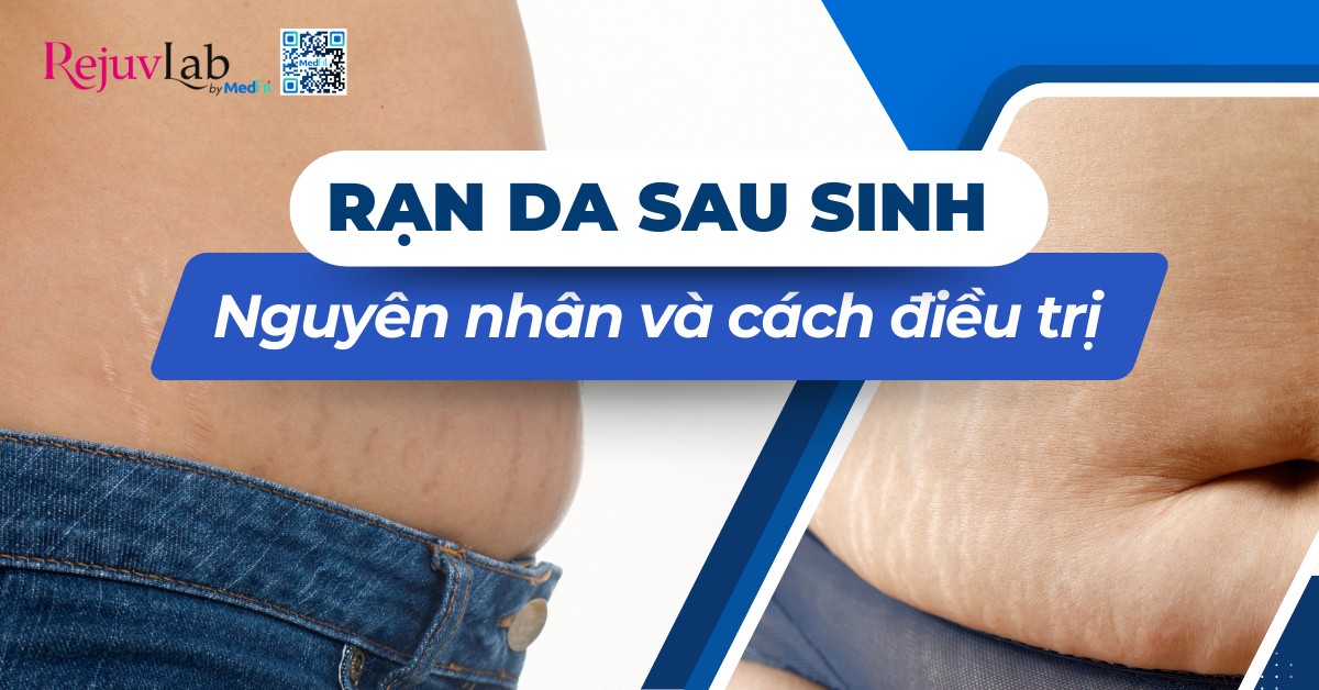 rạn da sau sinh