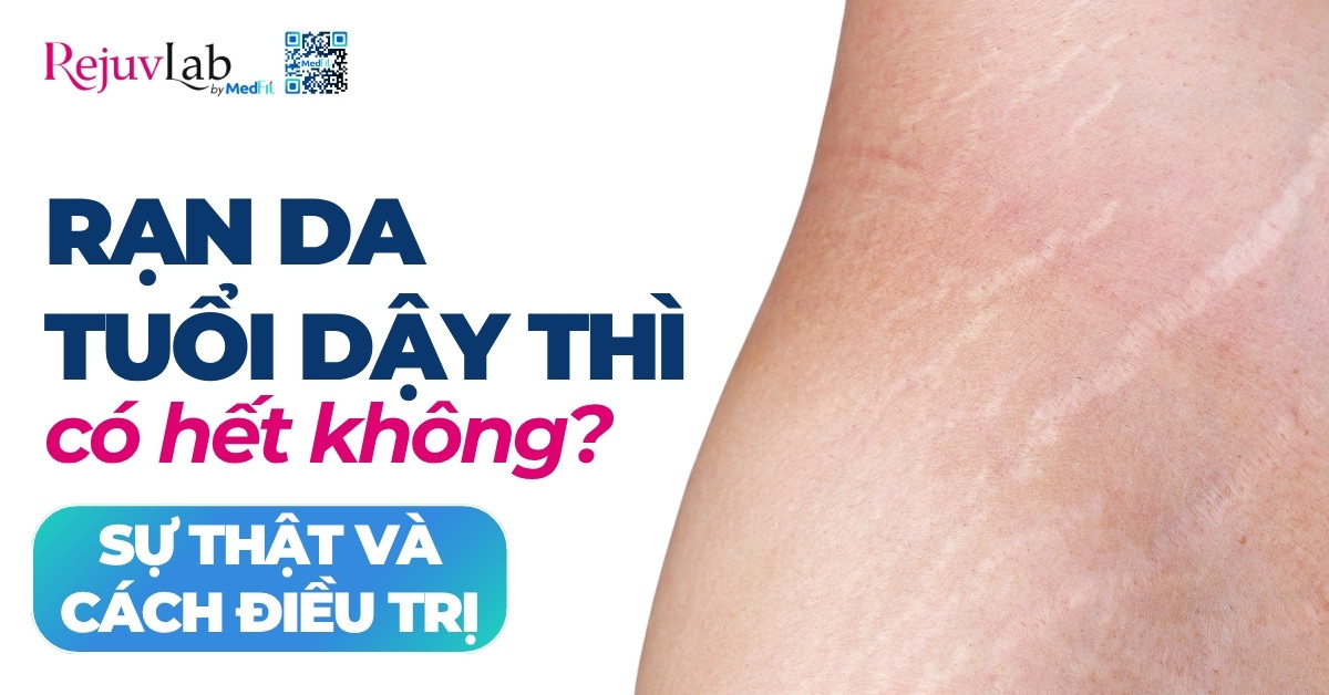 rạn da tuổi dậy thì có hết không sự thật và cách điều trị