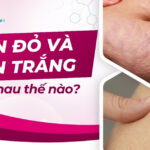 Rạn da tuổi dậy thì có hết không? Sự thật và cách điều trị 14 Rạn đỏ và rạn trắng khác nhau thế nào?