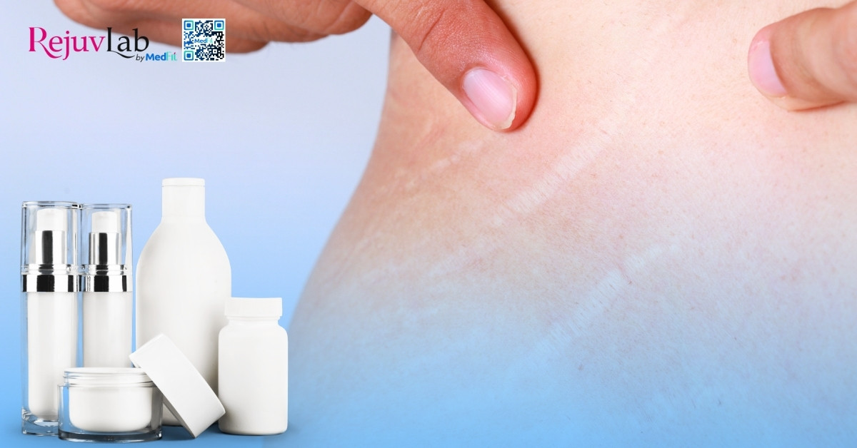 Rạn da tuổi dậy thì có hết không? Sự thật và cách điều trị 5 sản phẩm bôi thoa làm mờ vết rạn