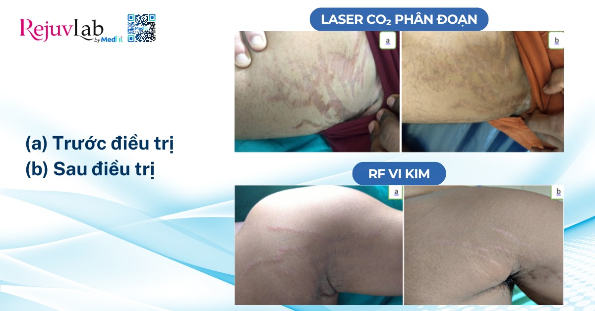 so sánh hiệu quả làm mờ vết rạn, trước điều trị (a) và sau điều trị (b) của phương pháp laser co2 phân đoạn (trên) và rf vi kim (dưới)