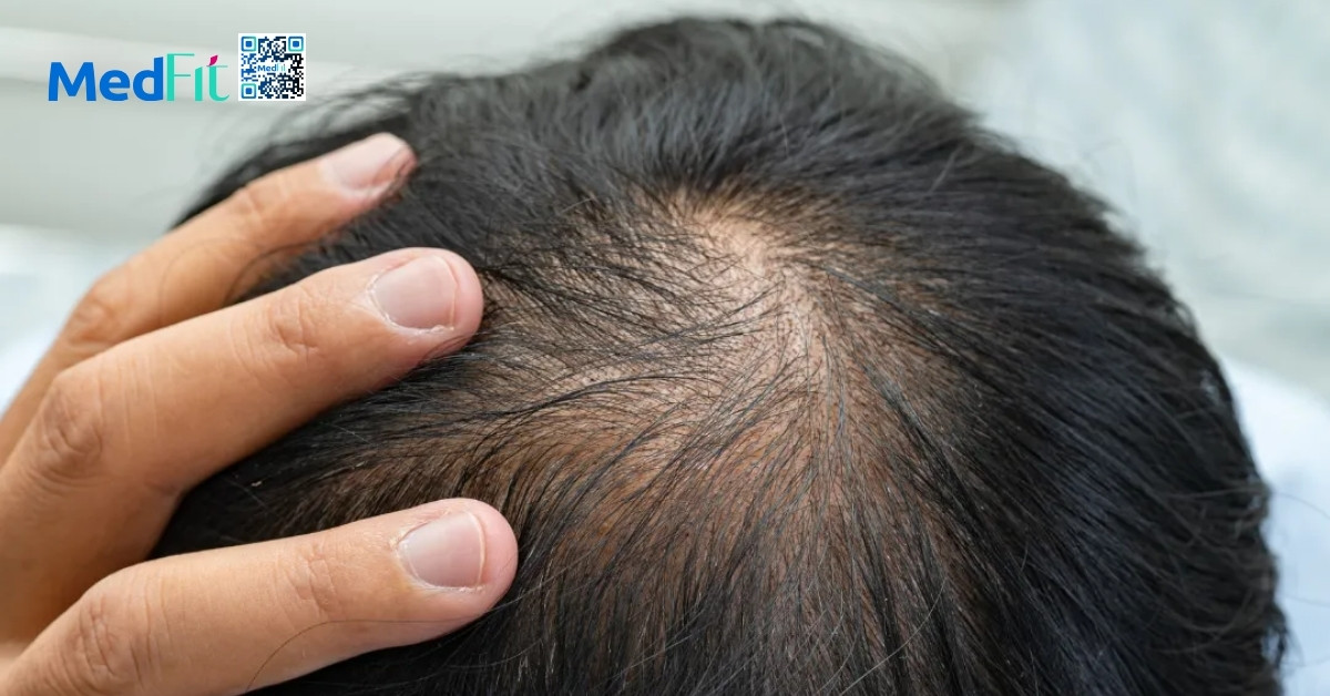 telogen effluvium