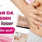 Laser SculpSure trong giảm mỡ khu trú: Cơ chế hoạt động và hiệu quả 4 Trị rạn da sau sinh bằng laser liệu có hiệu quả?