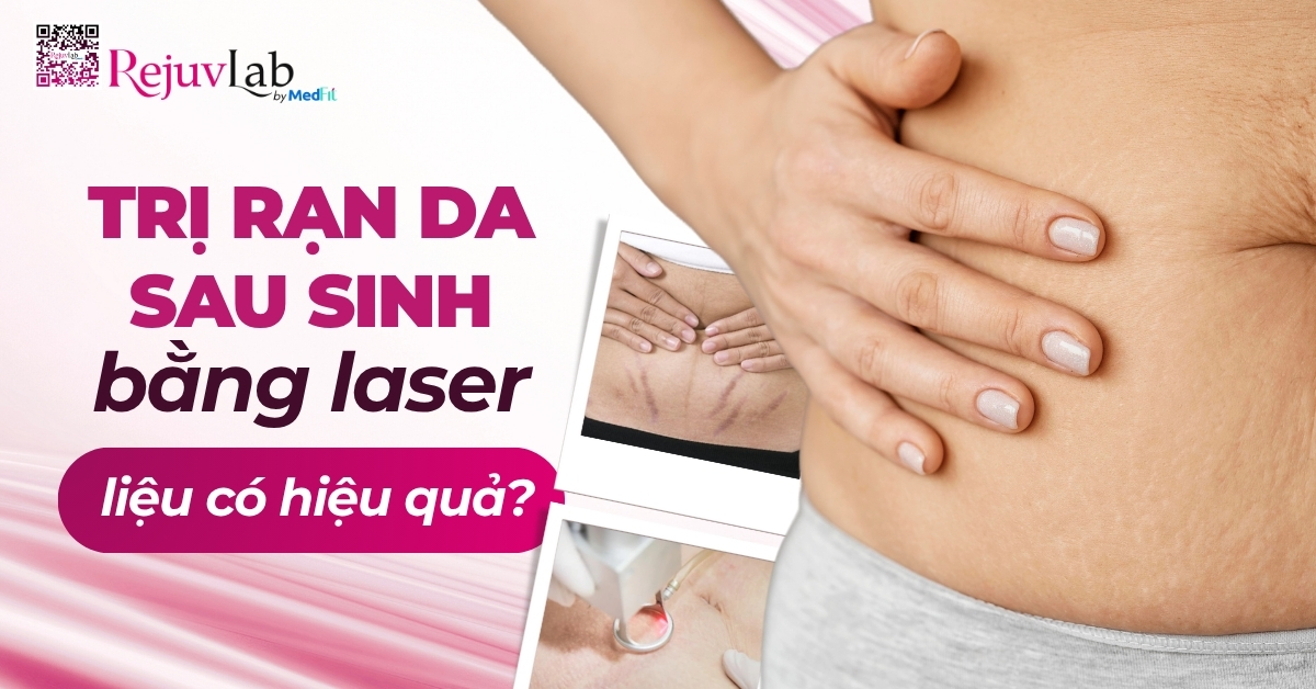 trị rạn da sau sinh bằng laser liệu có hiệu quả