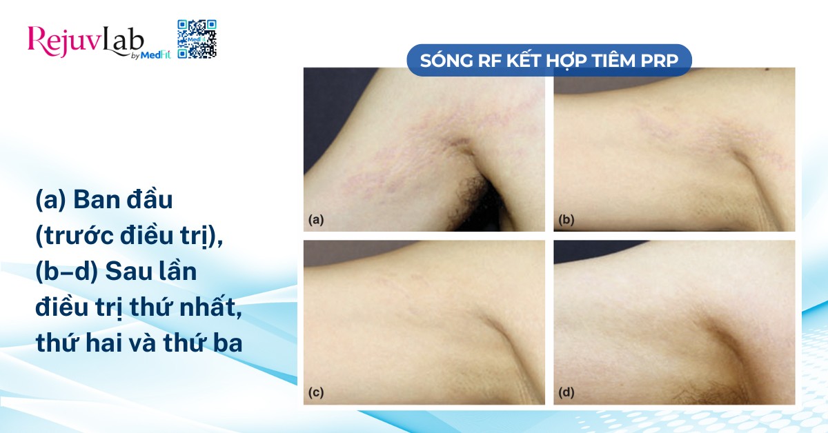 vết rạn da ở vùng nách phải của một phụ nữ 21 tuổi tại thời điểm ban đầu và sau các lần điều trị bằng sóng rf kết hợp tiêm prp