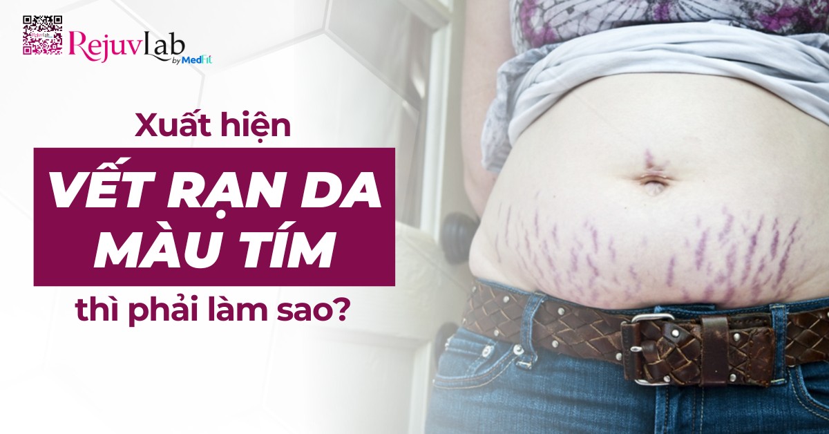 xuất hiện vết rạn da màu tím thì phải làm sao