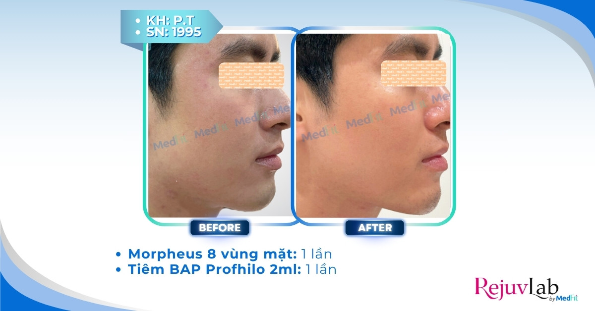 Ca lâm sàng nâng cơ trẻ hóa da bằng công nghệ hiện đại tại RejuvLab