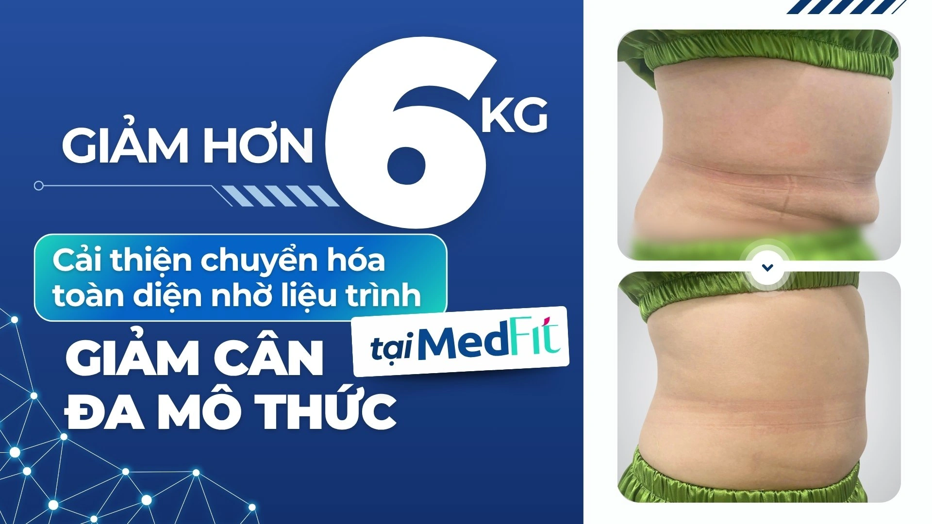 Giảm hơn 6kg- cải thiện chuyển hóa toàn diện nhờ liệu trình GCĐMT