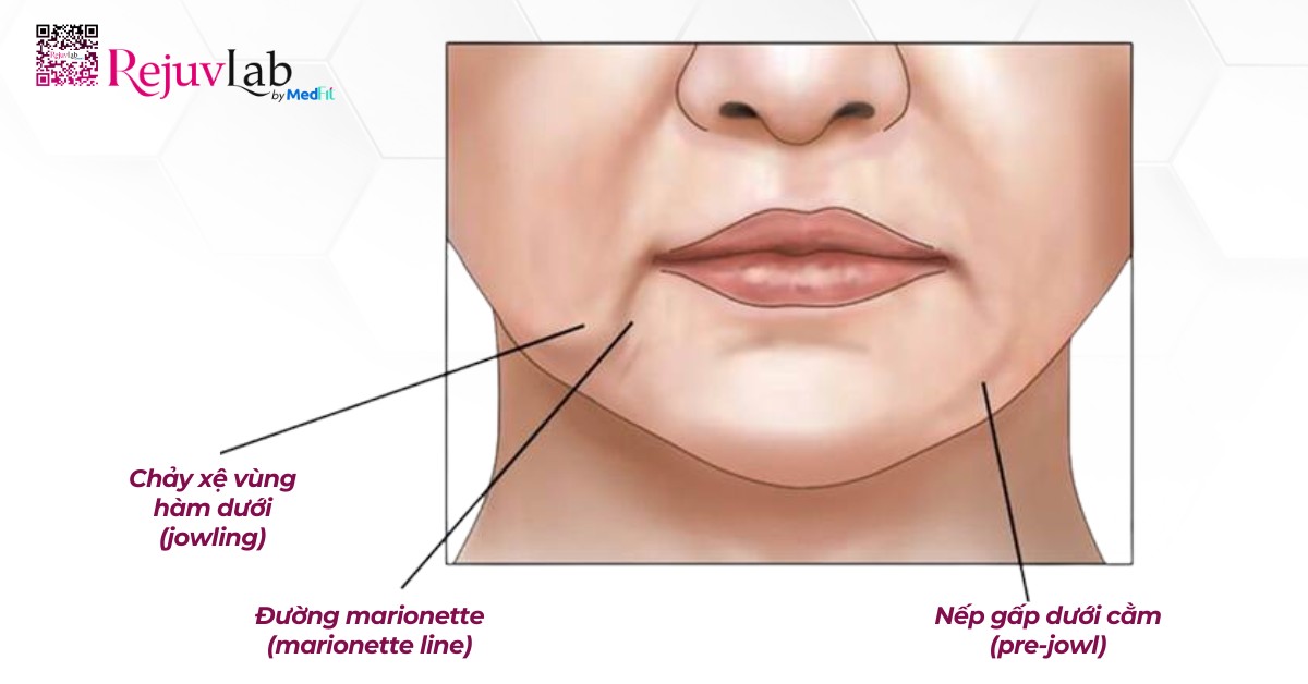 Hiện tượng chảy xệ vùng hầm dưới, nếp nhăn quanh miệng và nếp gấp dưới cằm (hình minh họa)