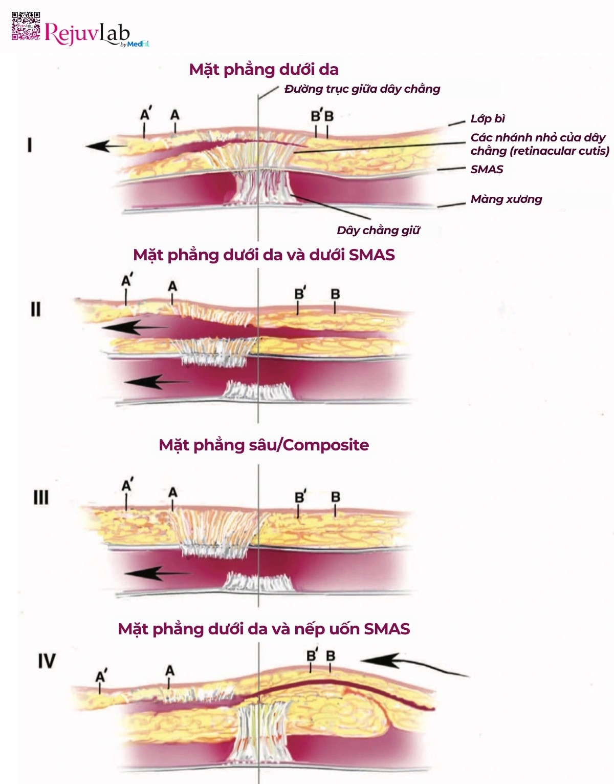 phẫu thuật thẩm mỹ trẻ hóa dây chắng