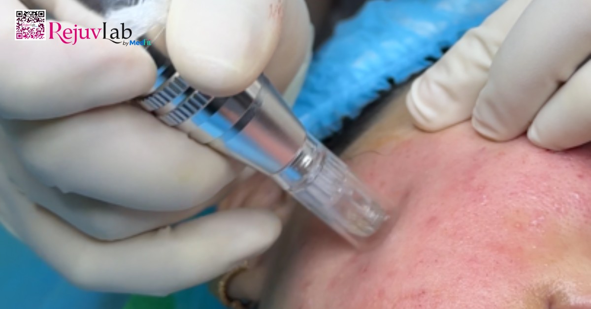 Meso không kim là gì và ứng dụng trong thẩm mỹ da liễu 8 Phi kim