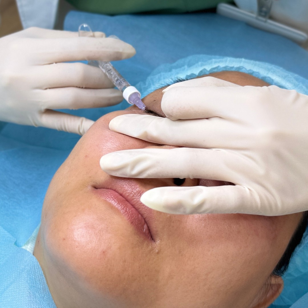 Tiêm rejuran i - Bước 2