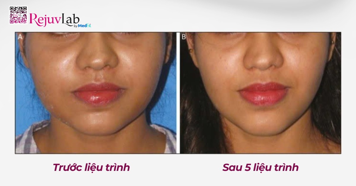 Trước và sau 5 liệu trình tiêm tan mỡ má, hình ảnh được trích từ nghiên cứu của Thomas và cộng sự (2018)