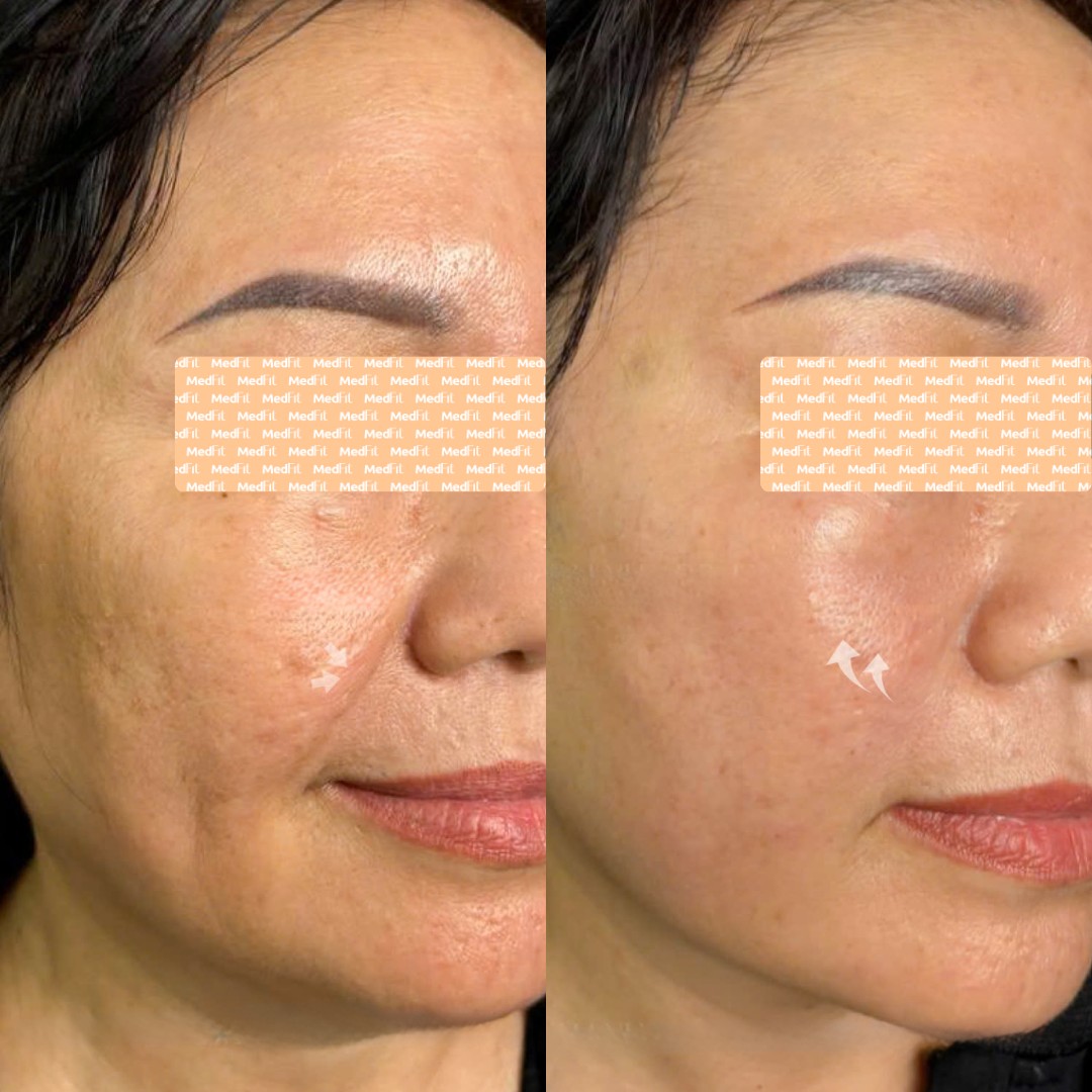 Xóa nếp nhăn - rãnh nhăn mờ đi
