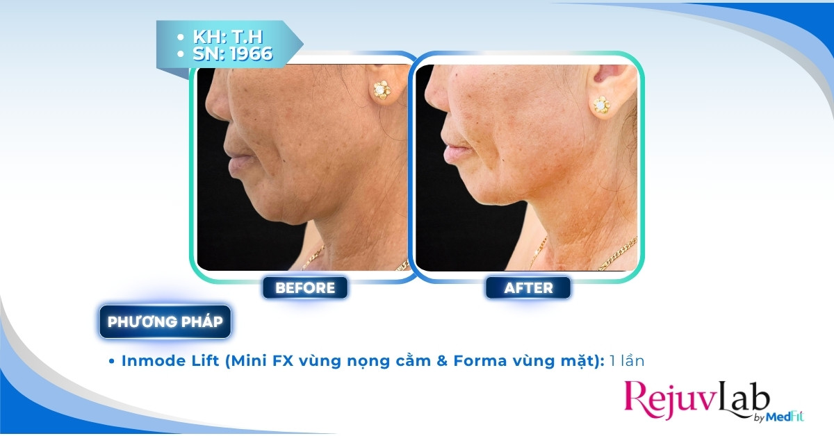 ca lâm sàng forma trẻ hóa da cổ