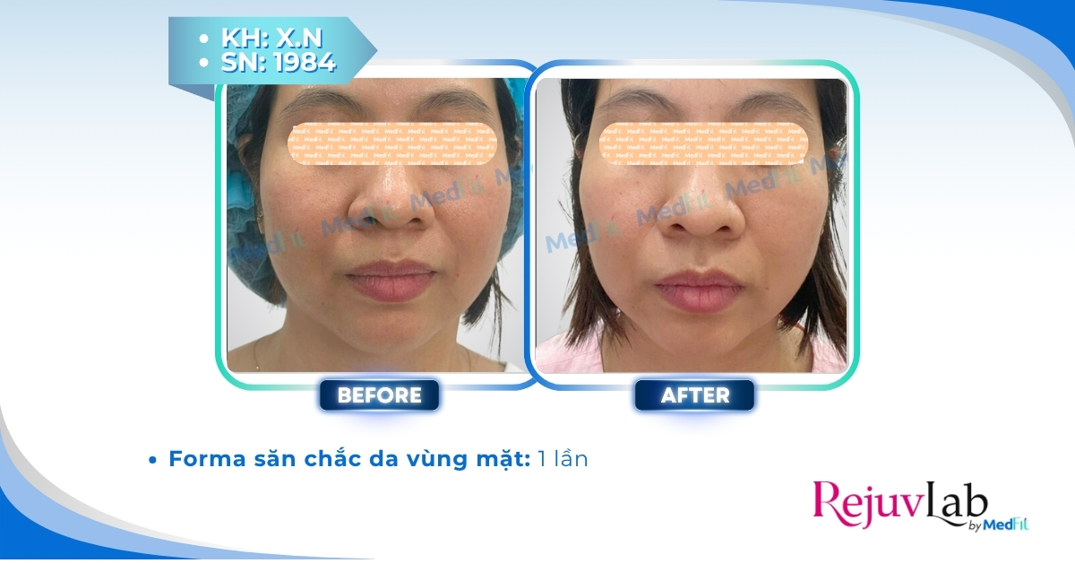 ca lâm sàng forma trẻ hóa vùng mặt