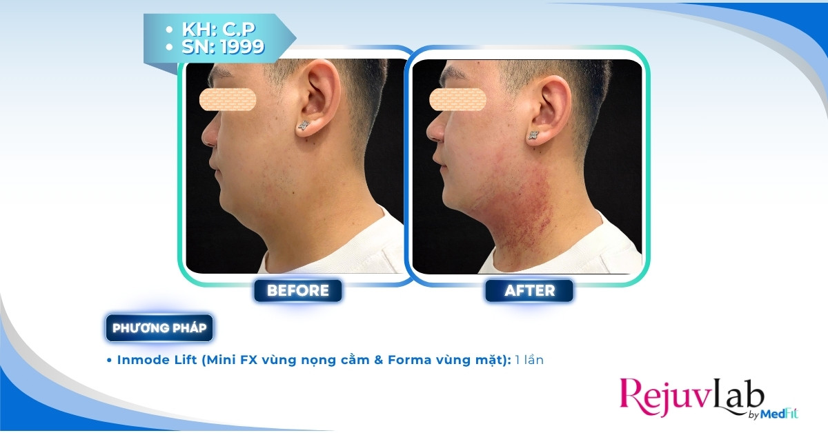 ca lâm sàng inmode lift giảm mỡ nọng cằm