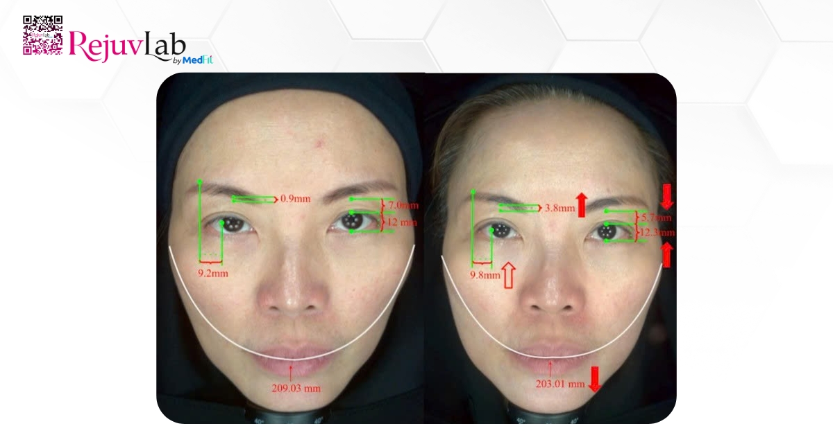 ca lâm sàng trẻ hóa bằng hifu