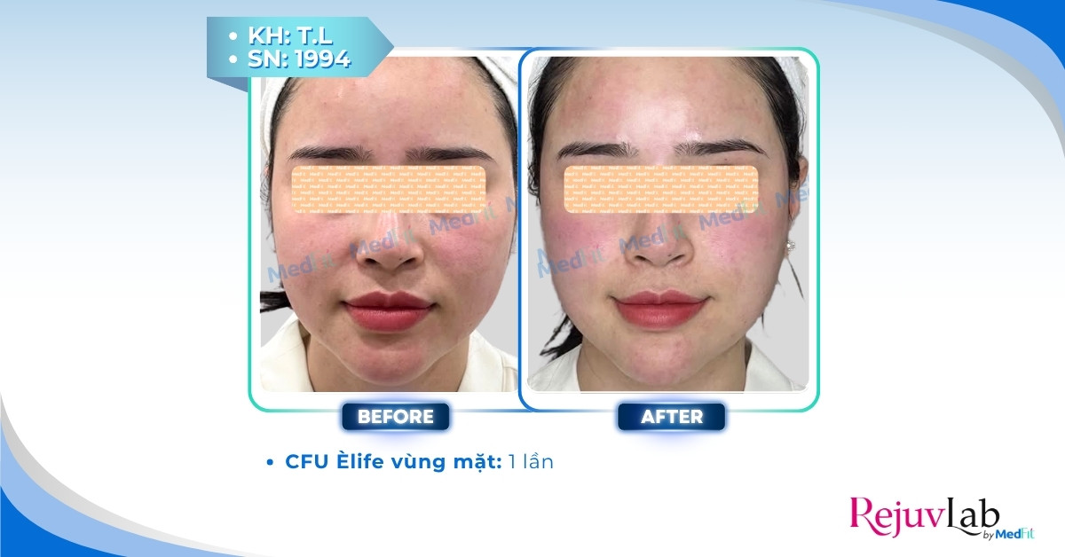 cls cfu giảm mỡ mặt