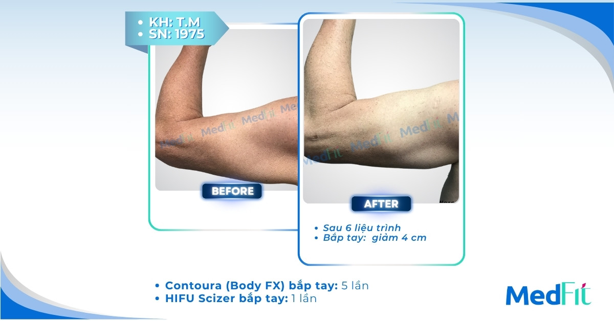 cls giảm mỡ bắp tay tại medfit