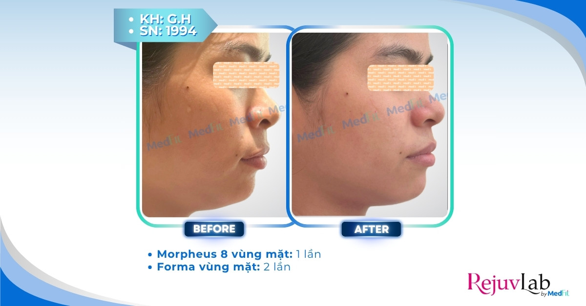 cls giảm mỡ má bằng công nghệ cao
