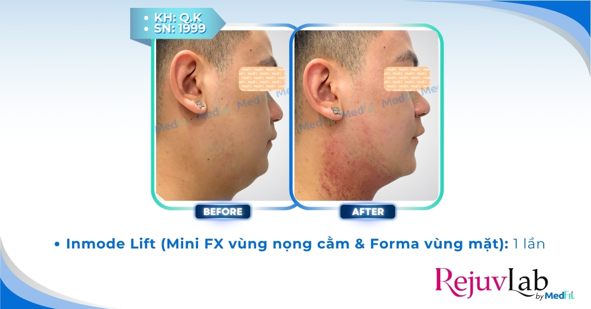 cls giảm mỡ mặt bằng inmode lift