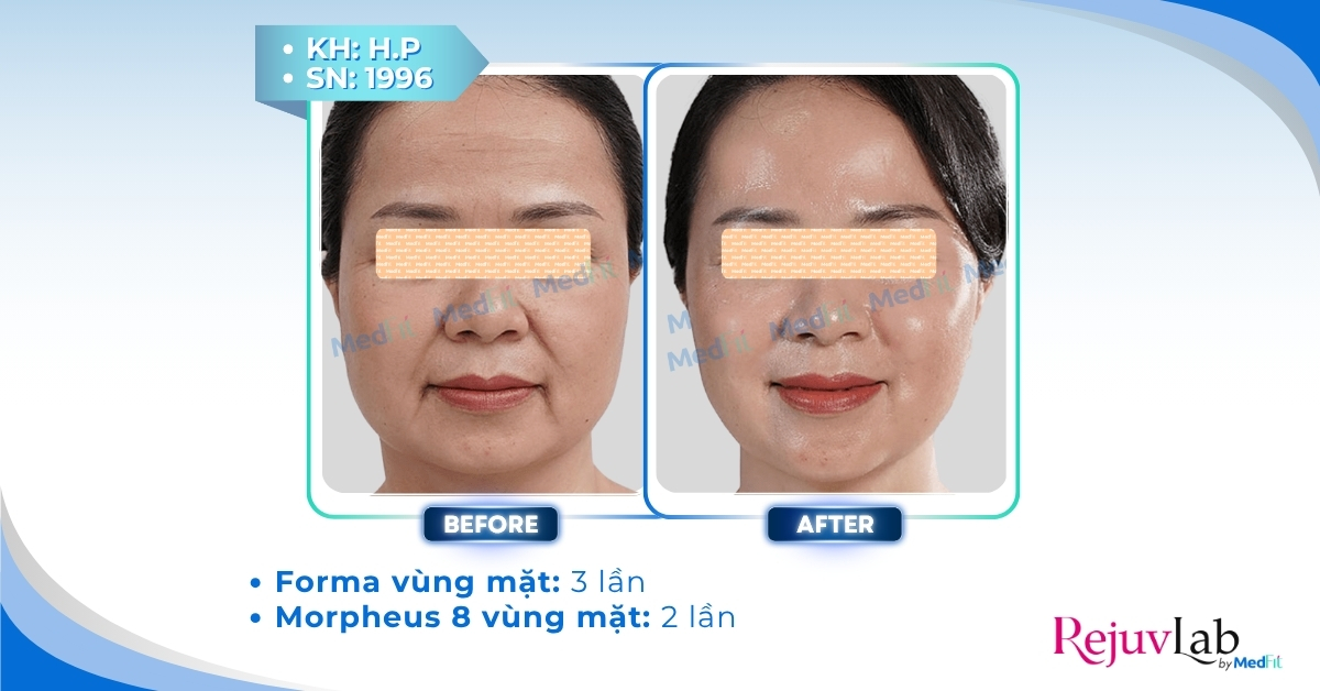 cls nâng cơ trẻ hóa bằng forma