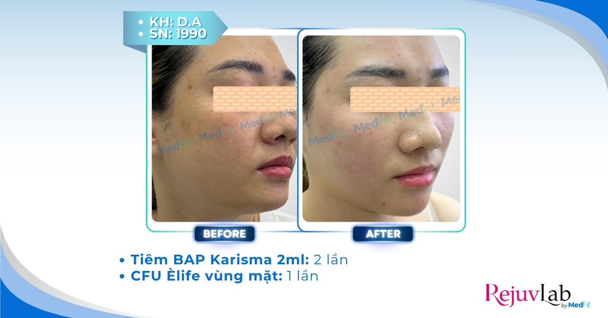 cls tiêm karisma bổ sung collagen