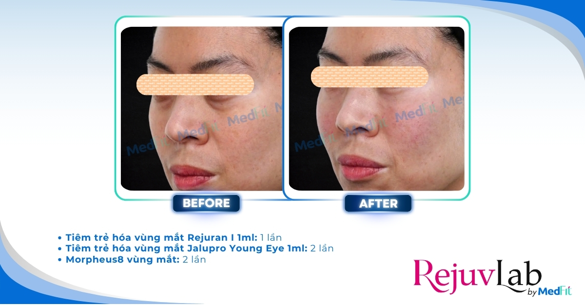 cls trẻ hóa vùng mắt tại rejuvlab