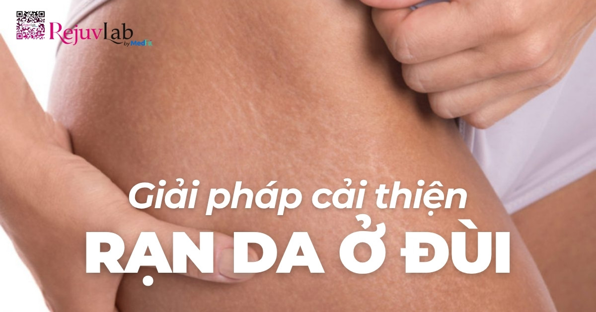 giải pháp cải thiện rạn da ở đùi