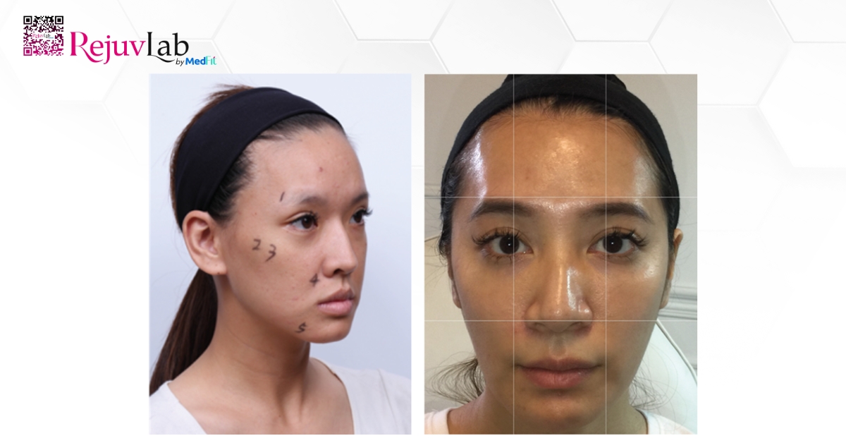 hiệu ứng nâng mặt ngay lập tức sau kỹ thuật true lift