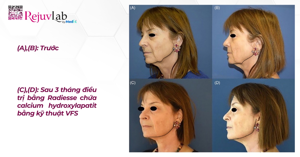 hình ảnh trích từ nghiên cứu tiêm radiesse chứa caha bằng kỹ thuật vfs