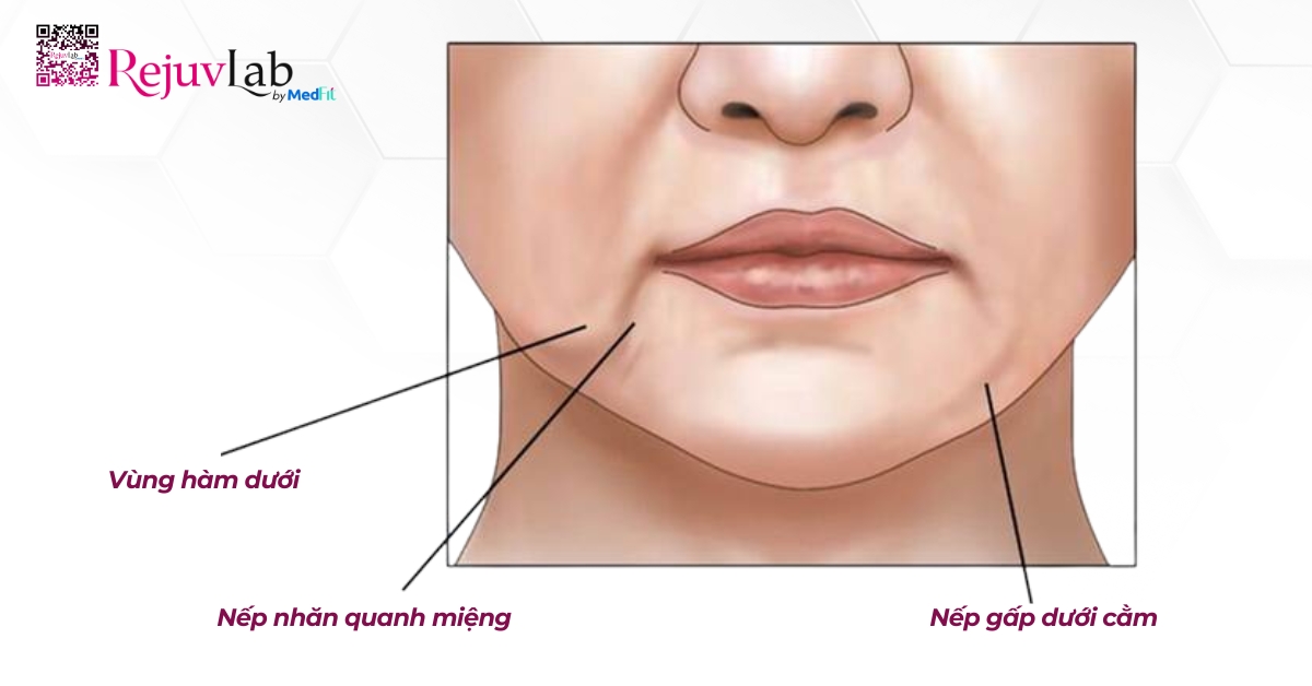hình minh họa các nếp nhăn vùng hàm dưới