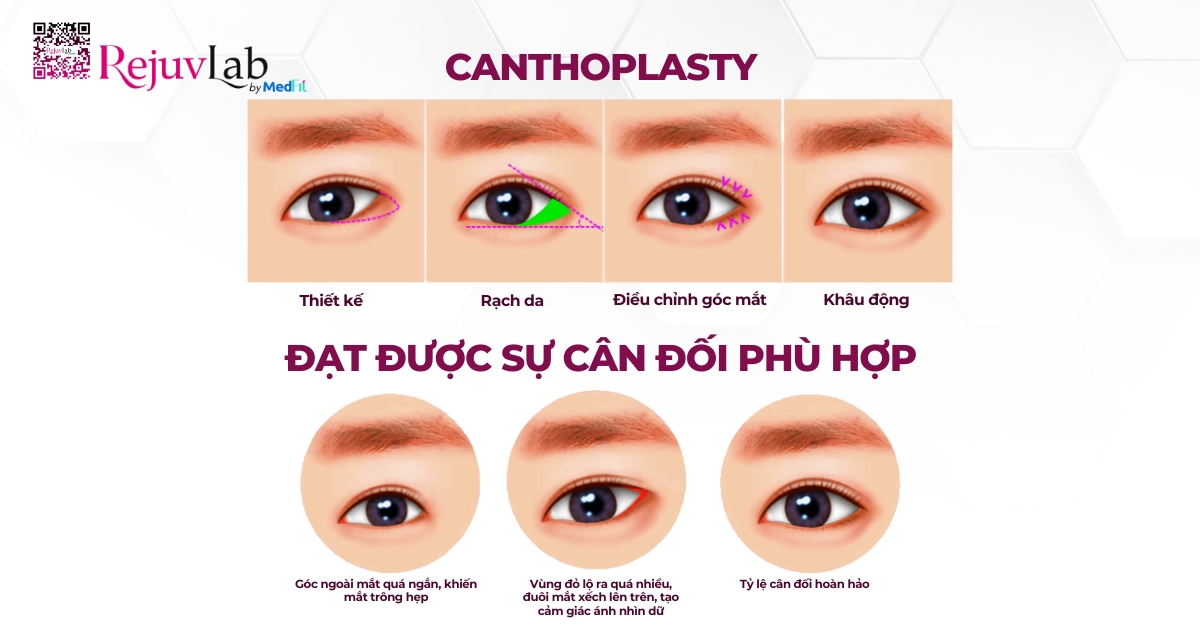 hình minh họa canthoplasty