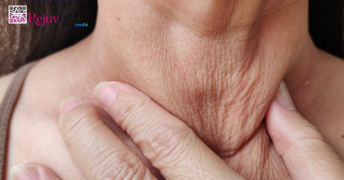 hình minh họa da cổ bị lão hóa