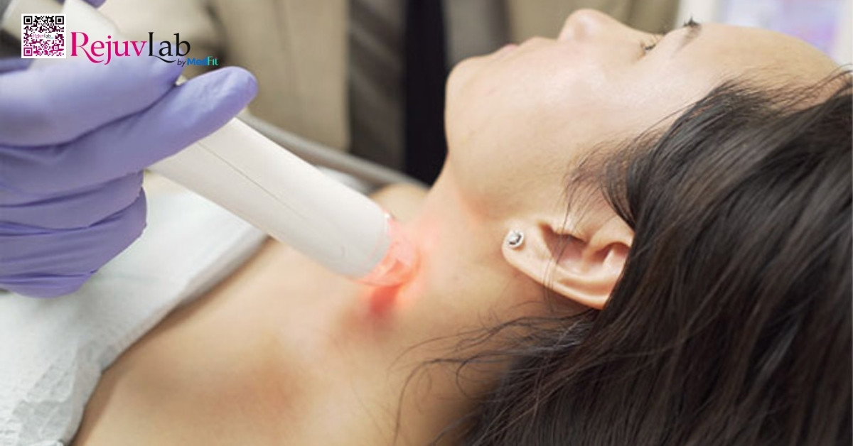 hình minh họa laser tái tạo vùng cổ