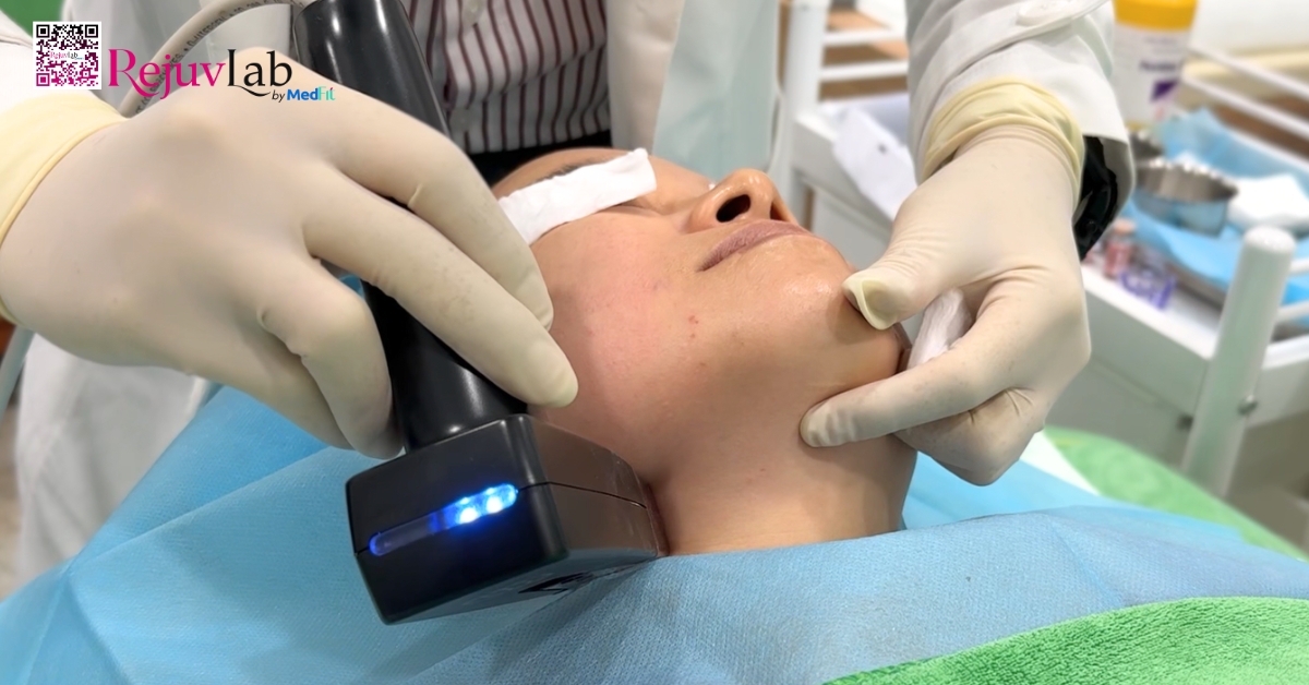 hình minh họa morpheus8 vùng cổ