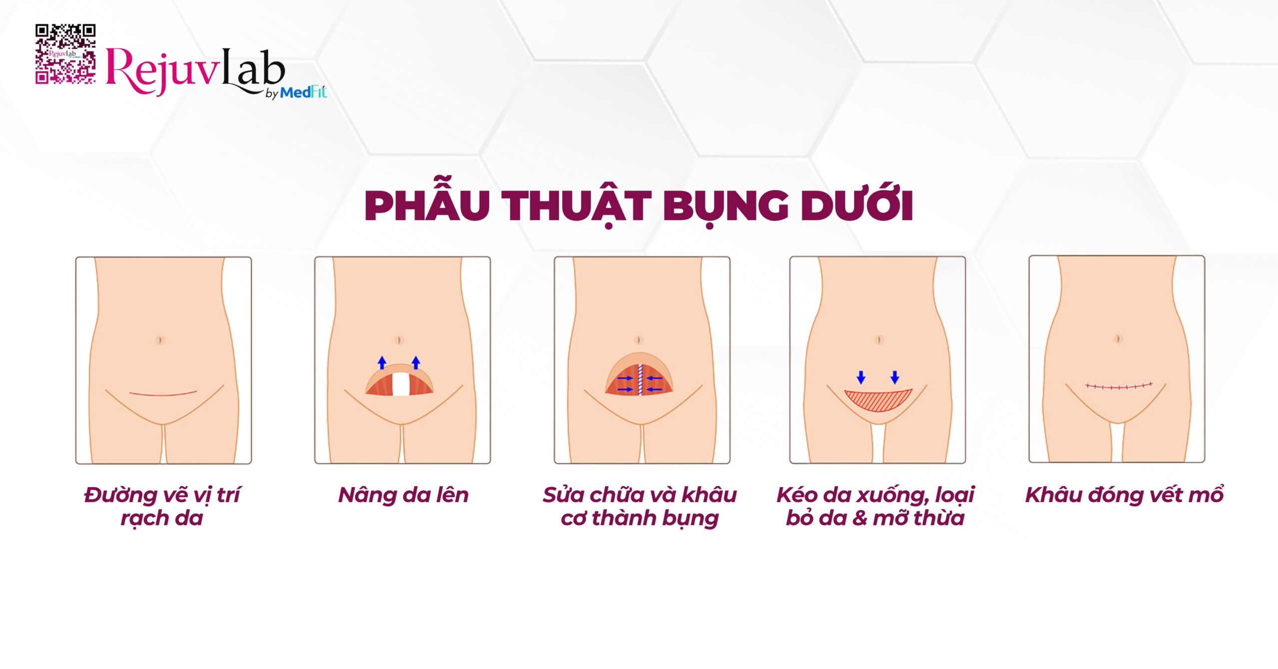 hình minh họa phẫu thuật bụng dưới (mini abdominoplasty)